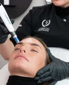 Kvinna som får microneedling behandling i ansiktet.