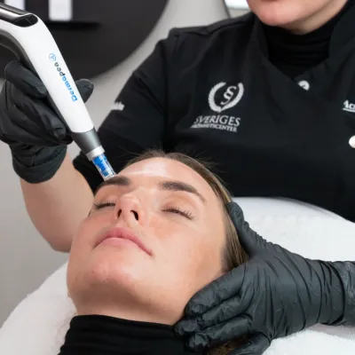 Kvinna som får microneedling behandling