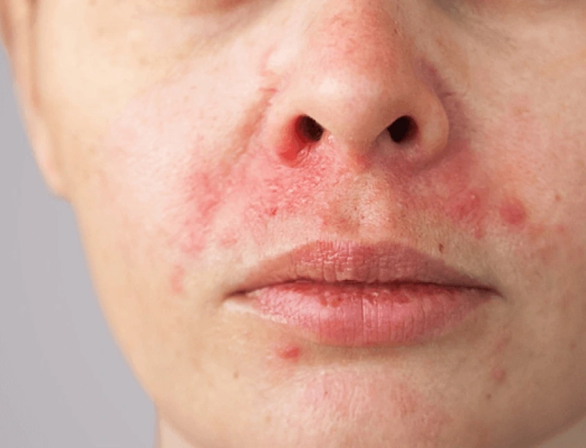 Ansikte med hudproblemet Perioral dermatit