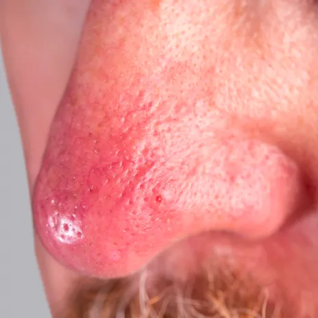 Bild av svår rosacea