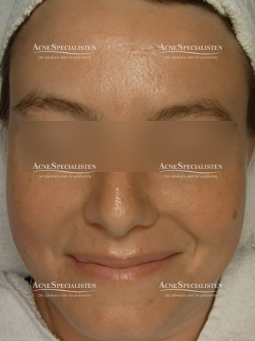 Rosacea resultat