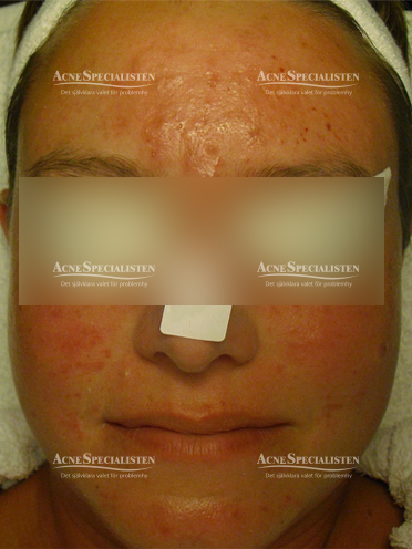 Rosacea resultat