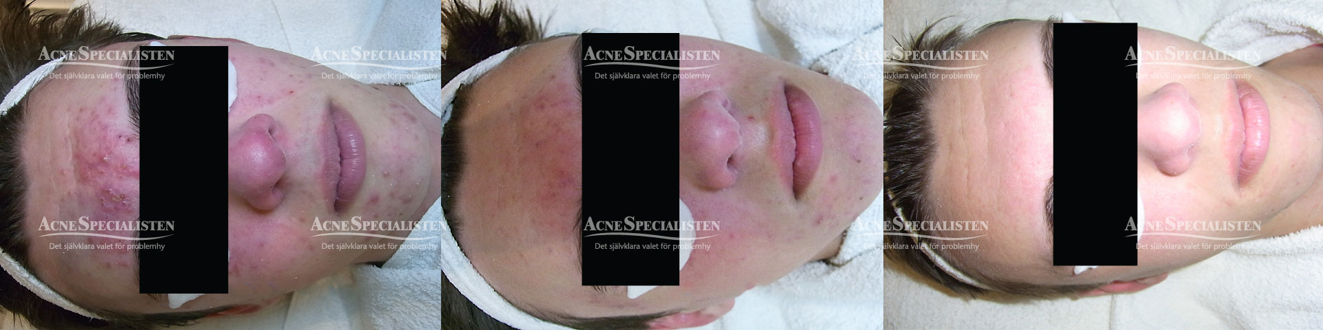 svår acne hudproblem före och efter bilder
